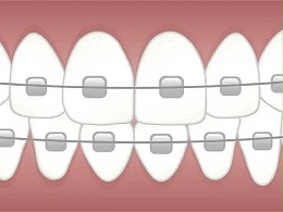 医用牙托自动整列|排列案例